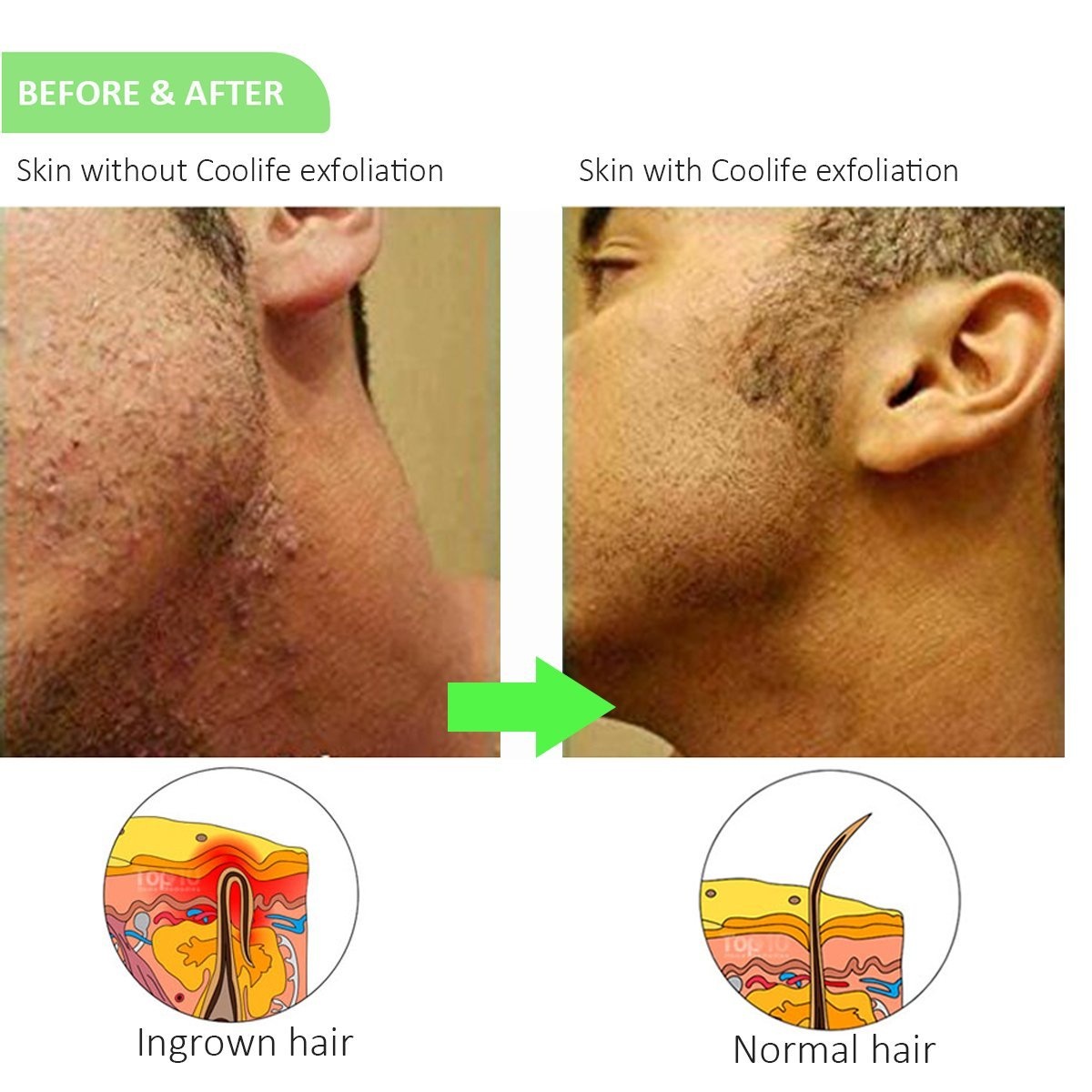 Coolife Ingrown Hair And Razor Bumps Treatment Mini Bristle